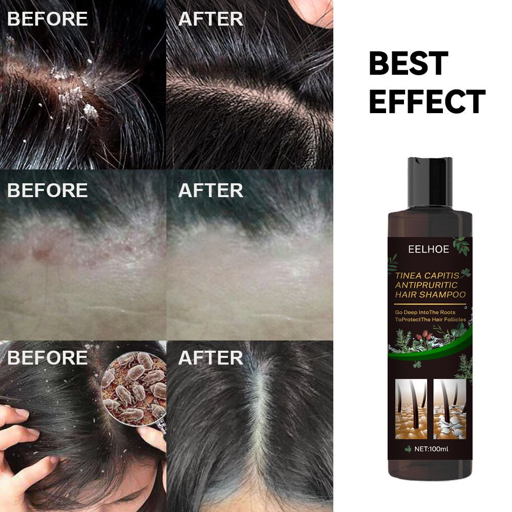 Dandruff Remover Shampoo Therapeutic Shampoo Treatment for Itching Flaking Scalp Psoriasis Seborrheic Dermatitis Hair Care 100ml