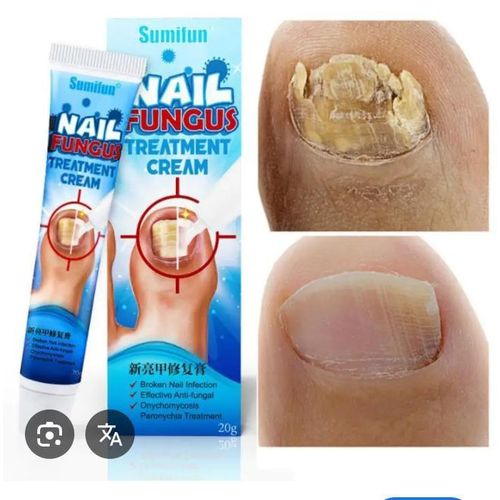 Sumifun Nail Fungus Treatment Cream – Repairs, Restores & Protects Damaged Nails – 20g