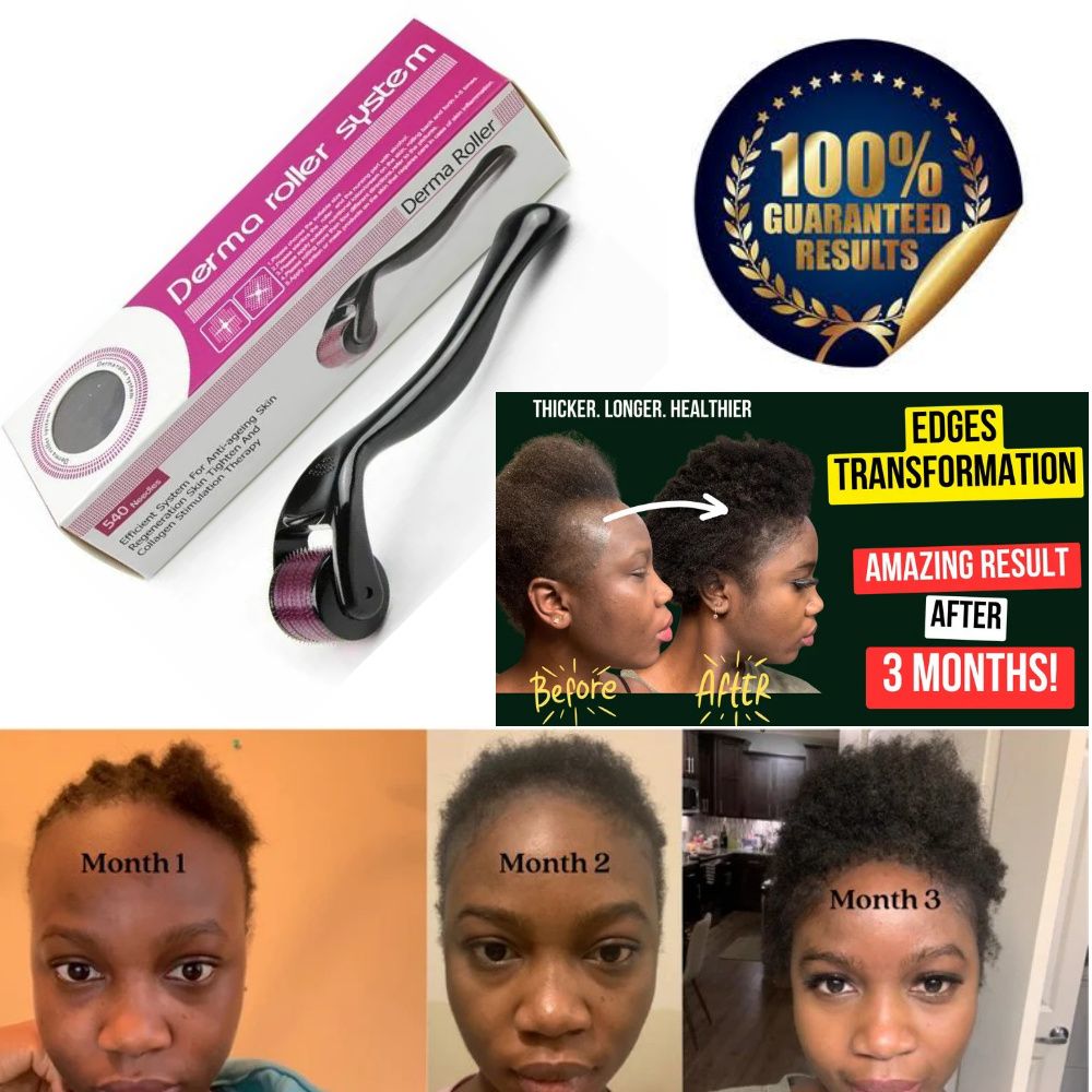 Super effective hair loss solution | Fast result | dermaroller | For Balding, Alopecia | Hairline| Beard growth | Edges| Hair growth |0.5mm