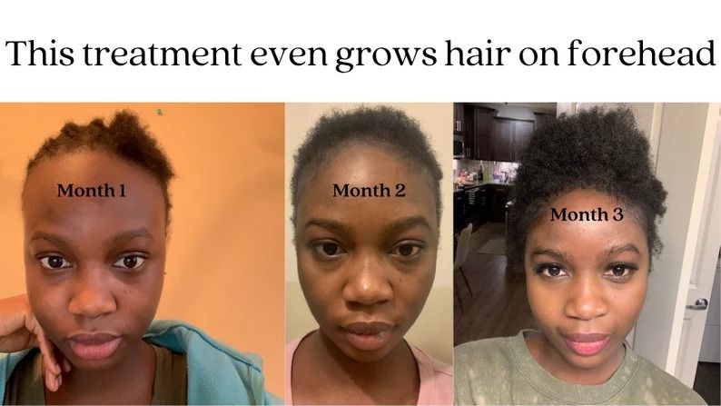 Super effective hair loss solution | Fast result | dermaroller | For Balding, Alopecia | Hairline| Beard growth | Edges| Hair growth |0.5mm