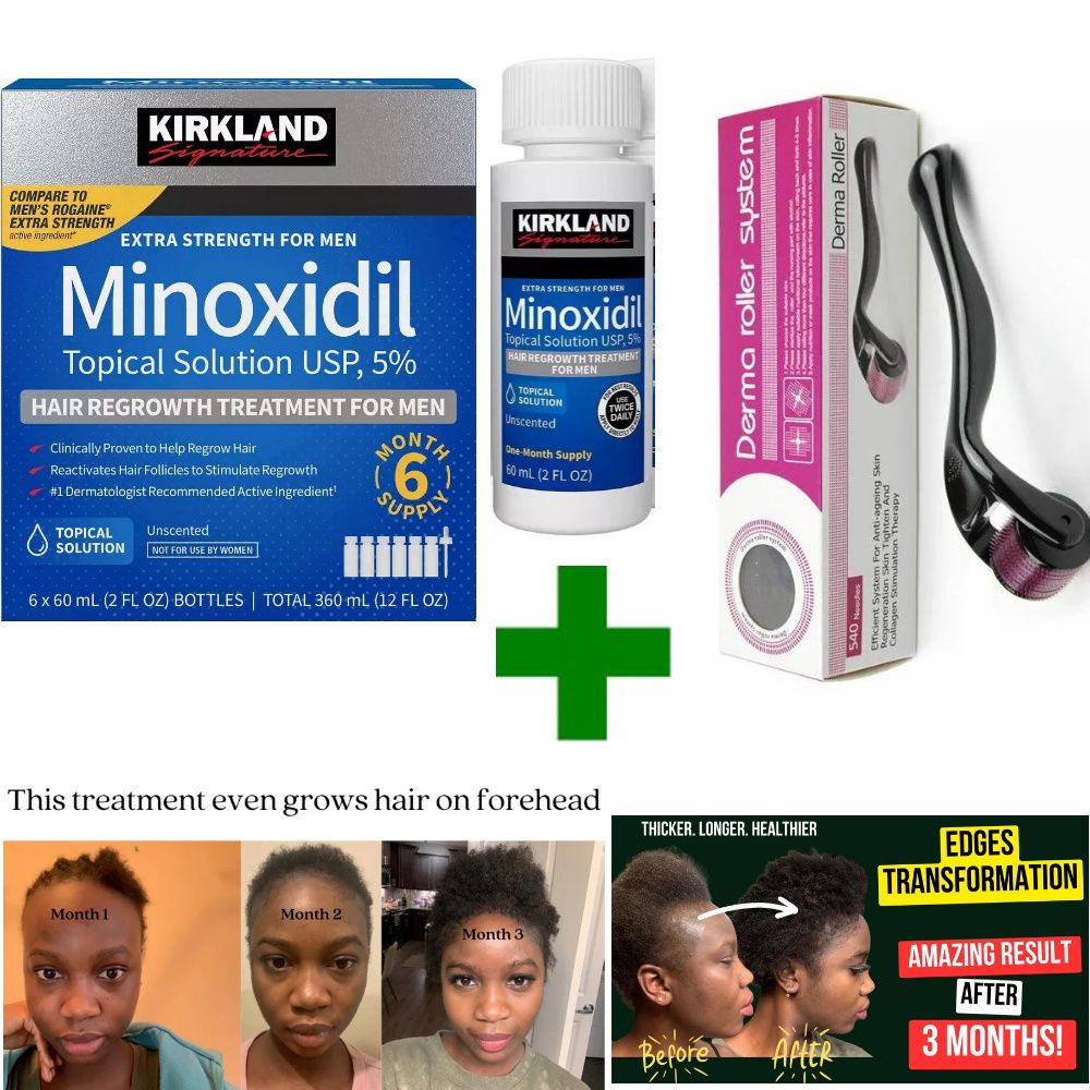 Super Effective Hair Loss Solution | Hair Growth |scalp hair |Best Derma Roller 0.5MM+Minoxidil
5%| Extra Strength| Beard Growth Kit |Hair Treatment|GETthicker hair|improves hair
texture|reduces hairt