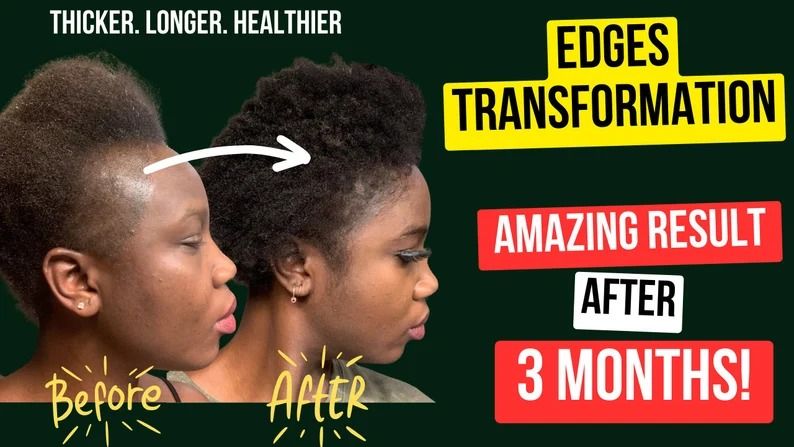 Super Effective Hair Loss Solution | Hair Growth |scalp hair |Best Derma Roller 0.5MM+Minoxidil
5%| Extra Strength| Beard Growth Kit |Hair Treatment|GETthicker hair|improves hair
texture|reduces hairt