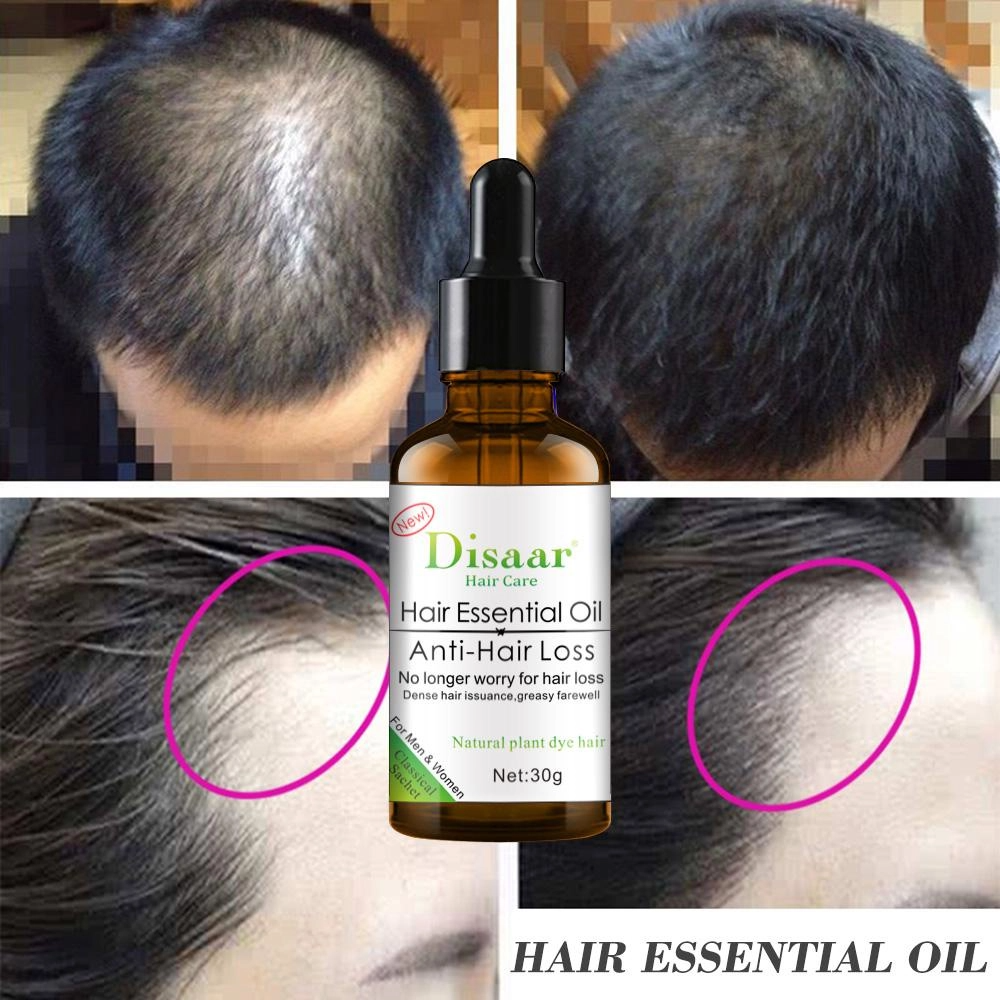 Hair Growth Essential Oil For Baldness, Hair Loss, Thinning & Scalp Repair With Natural Nutrients For Stronger, Fuller, Healthier Hair