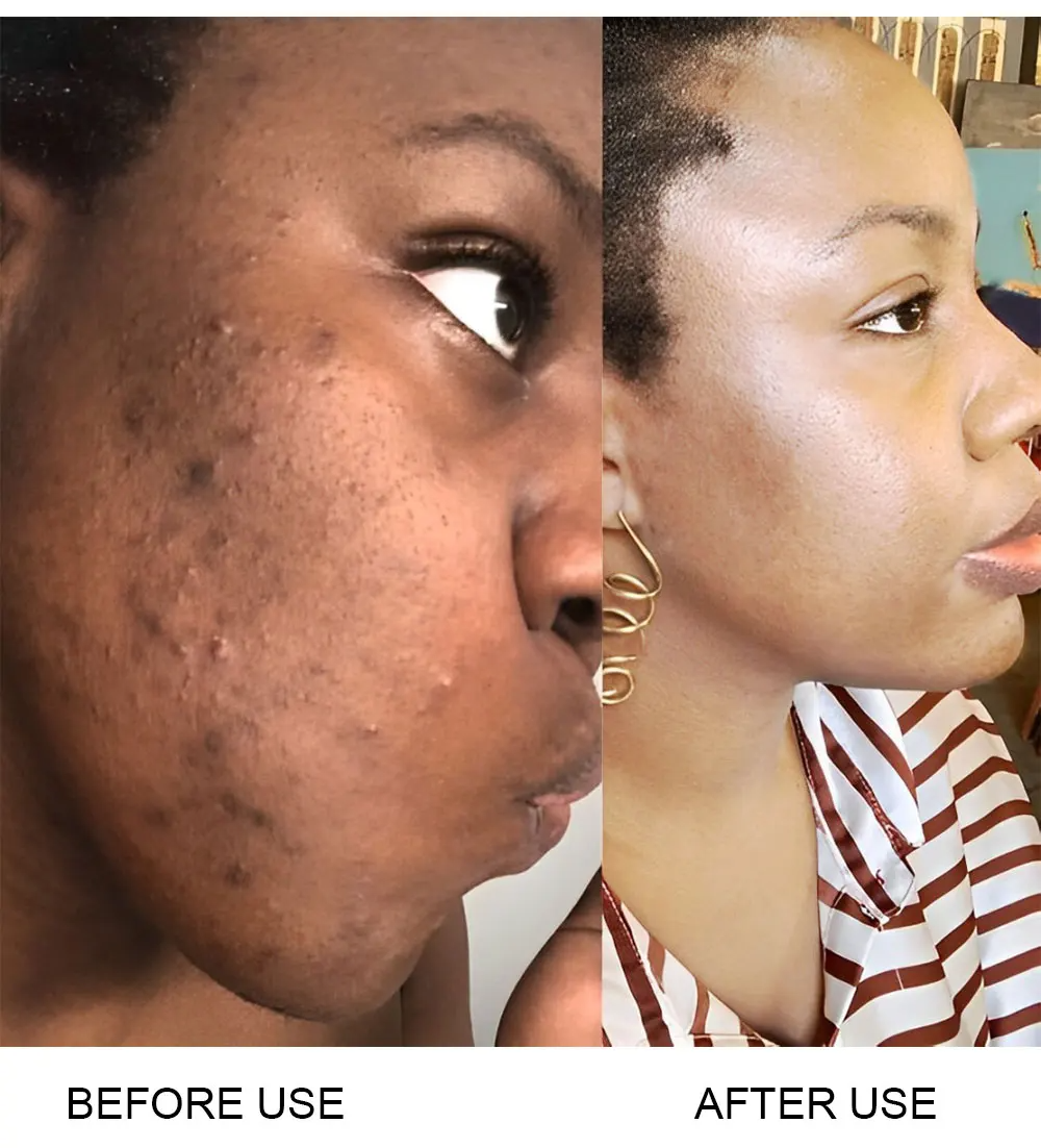 Gluta Master Bye Acne Gummies Clears Acne, Reduces Breakouts, Fades Dark Spots, Improves Skin Texture, Promotes Smooth Healthy Radiant And Glowing Skin From Within