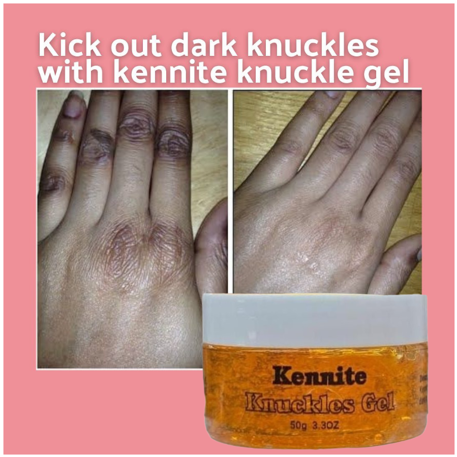 Kennite Fast Action Knuckles Brightening Gel For Dark Knuckles Elbows Knees And Spots Visible Results In 5 Days Intensive Brightening Gel That Lightens Dark Knuckles And Restores A Smooth Even Skin T