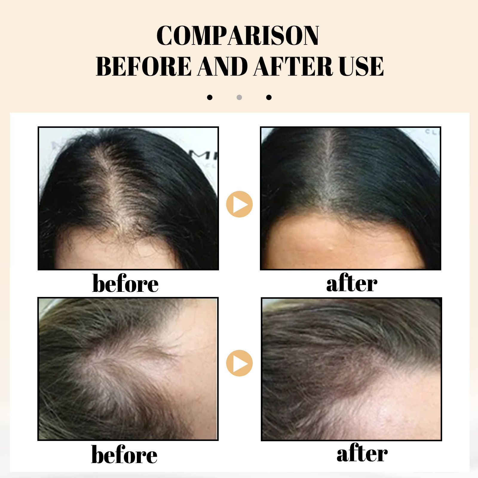 EELHOE rice anti shedding shampoo moisturizes the scalp, cleanses hair, repairs damaged hair, nourishes and solidifies hair. Shampoo