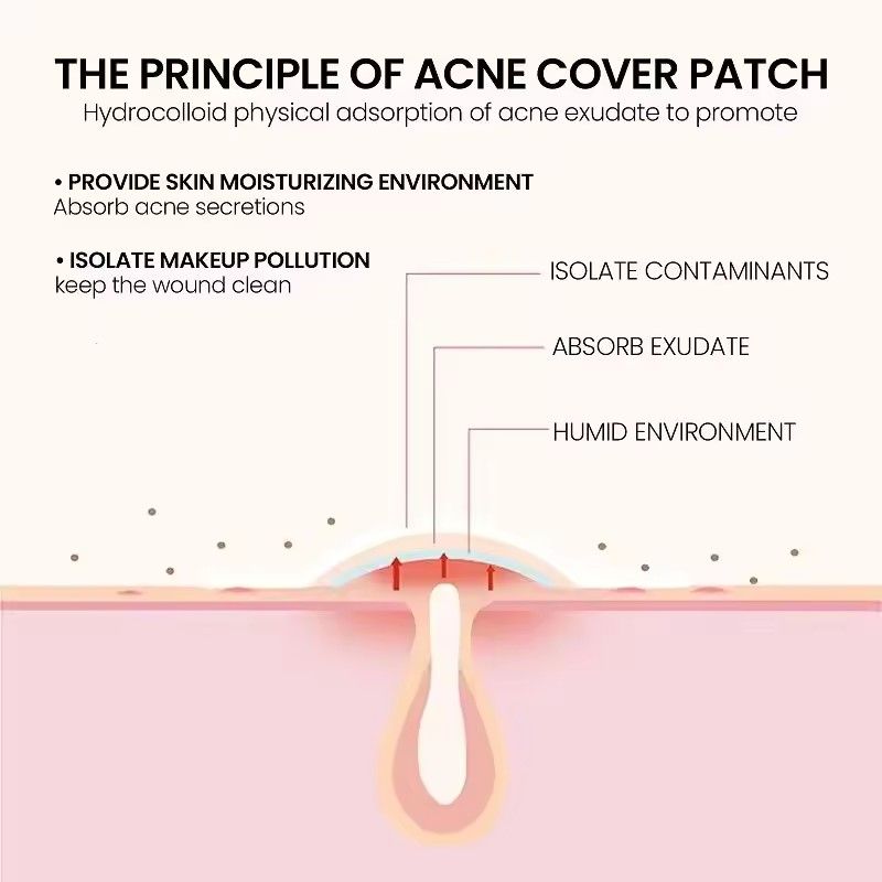 200pcs Repair Acne Patch Facial Skin Care Fade Blemishes Pimple Marks Closed Acne Blemishes Cover Acne Pimple Repair Patch