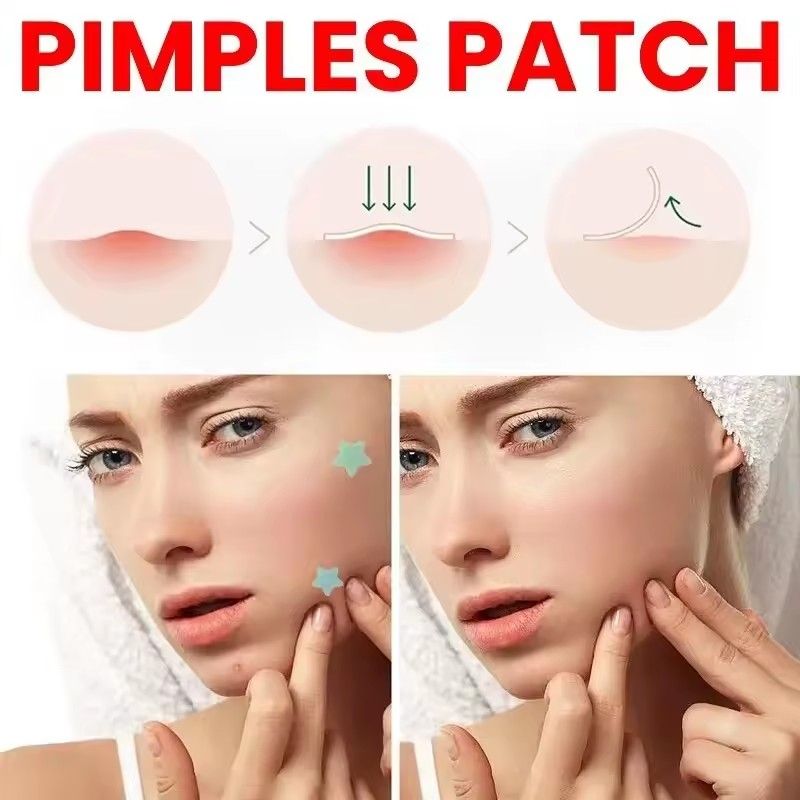 200pcs Repair Acne Patch Facial Skin Care Fade Blemishes Pimple Marks Closed Acne Blemishes Cover Acne Pimple Repair Patch