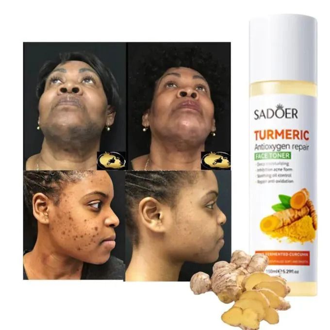 SADOER 4PCS Turmeric Set:Tumeric Cleanser + Face Toner +Face Serum + Face Cream , with unparelled Vitamin C capabilities, Helps in Preven Acne, Sooth, Hydrate, Lighten Acne Marks