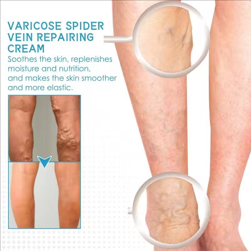 Varicose Vein Repair Cream Effective Relieves Leg Bulge Pain Treatment Cream Vasculitis Phlebitis Mprove Blood Circulation Cream