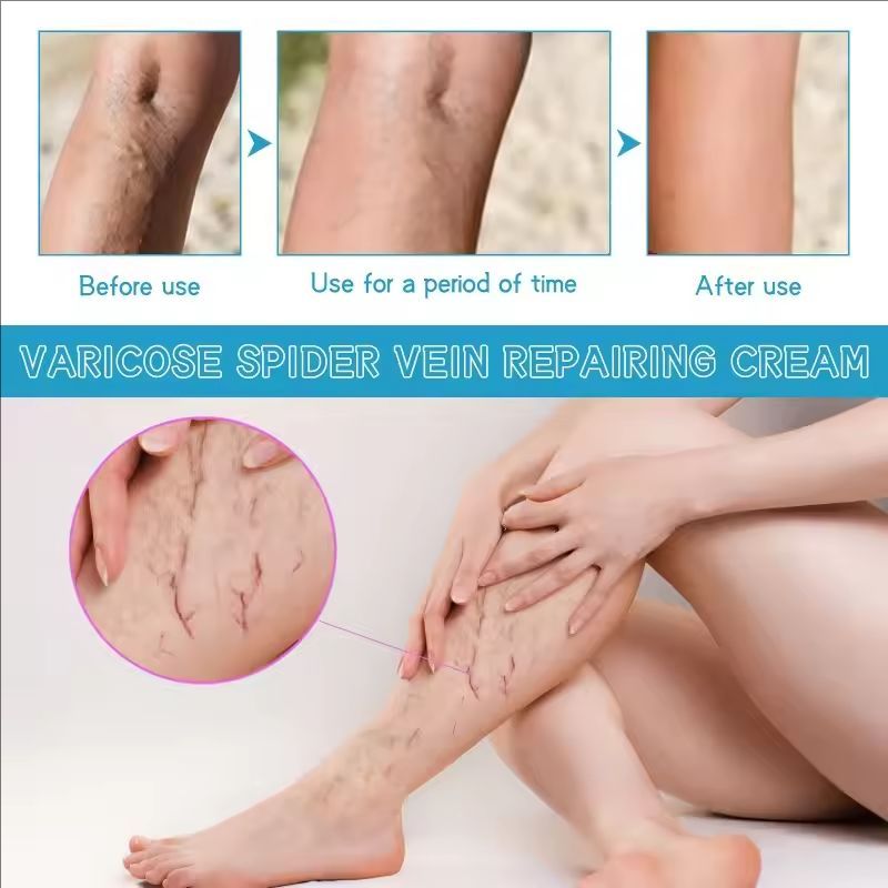 Varicose Vein Repair Cream Effective Relieves Leg Bulge Pain Treatment Cream Vasculitis Phlebitis Mprove Blood Circulation Cream