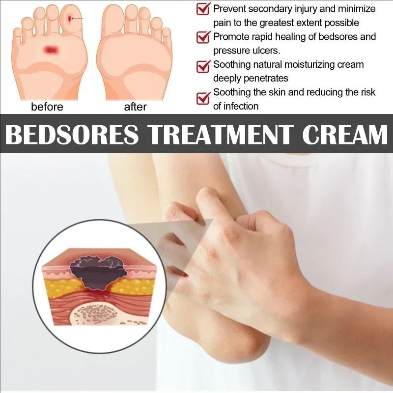Decubitus Cream Pressure Sore Ulcer Skin Relief Ointment Bed Sore Wound Healing Treat Anti Dry Repair Moisturizing Body Care