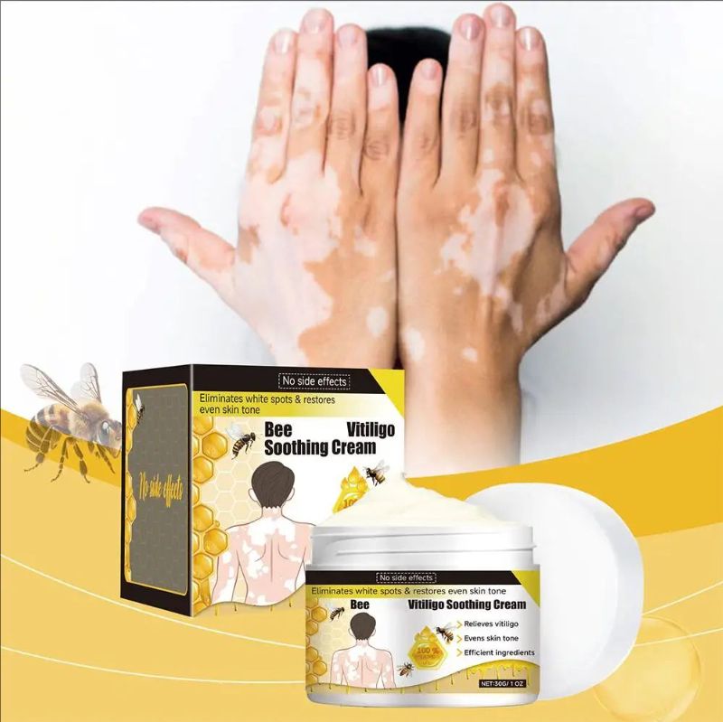 Vitiligo Treatment Cream Natural Relief Skin Treatment Eliminate Soothing Removal Pigment Ointment Vitiligo White Spot N8B4
