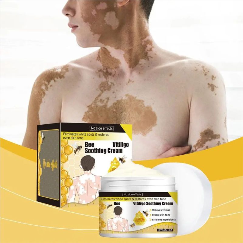 Vitiligo Treatment Cream Natural Relief Skin Treatment Eliminate Soothing Removal Pigment Ointment Vitiligo White Spot N8B4