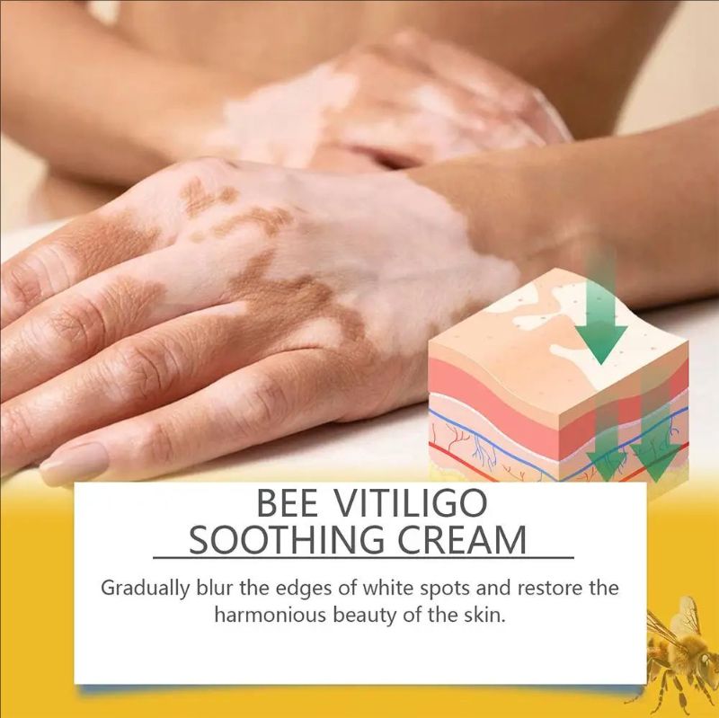 Vitiligo Treatment Cream Natural Relief Skin Treatment Eliminate Soothing Removal Pigment Ointment Vitiligo White Spot N8B4