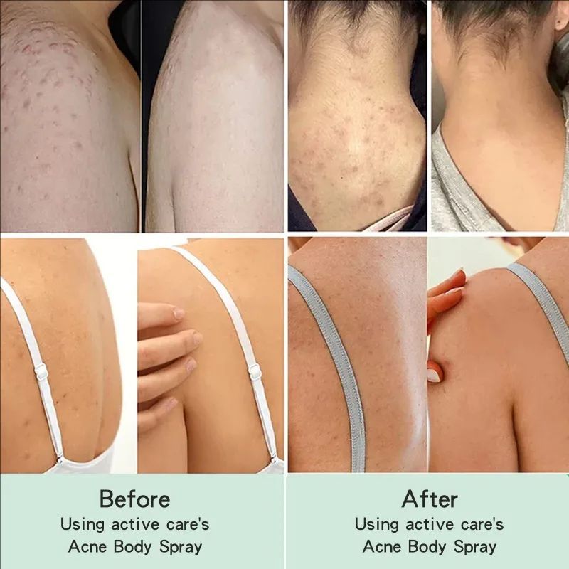 Back Acne Repair Spray Acne Removal Essence Oil Oil Butt Shoulder Care Cream Control Back Whitening Moisturize Removal Spray