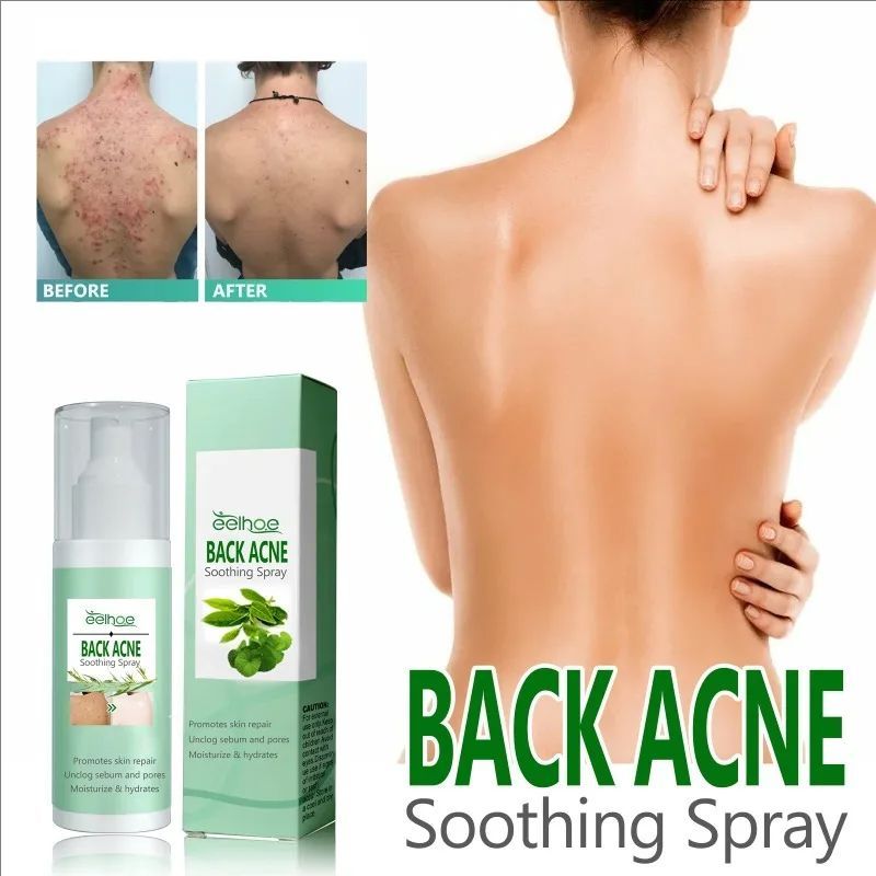 Back Acne Repair Spray Acne Removal Essence Oil Oil Butt Shoulder Care Cream Control Back Whitening Moisturize Removal Spray