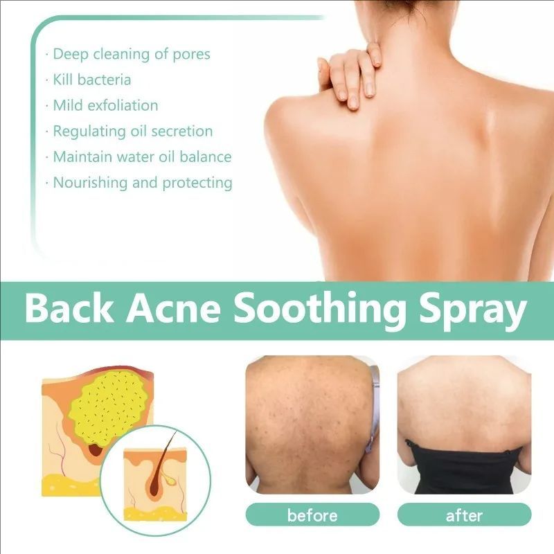 Back Acne Repair Spray Acne Removal Essence Oil Oil Butt Shoulder Care Cream Control Back Whitening Moisturize Removal Spray