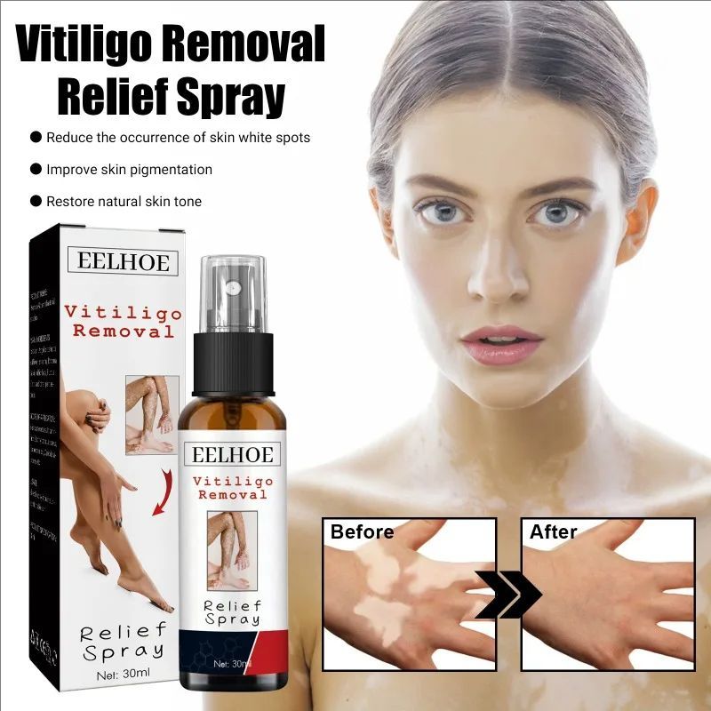 Photo inspiration: Best Price For Vitiligo Treatment Relief Spray Skin Treatment White Photo Inspiration