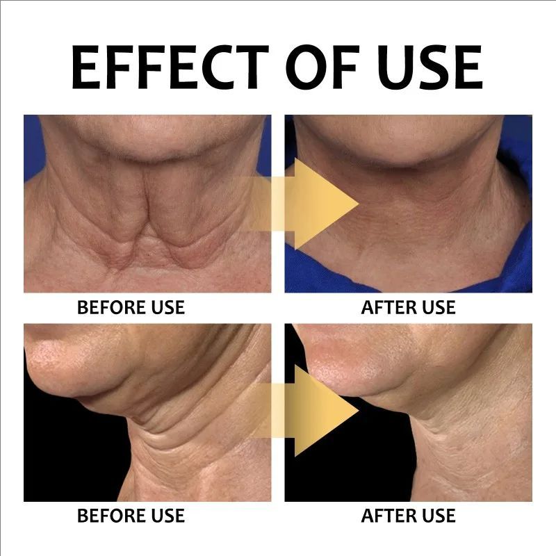 Neck Lines Protein Cream Moisturis Nourish Lift Neck Eliminate Double Chin Eliminate Neck Fine Lines Anti-ageing Rejuvenation
