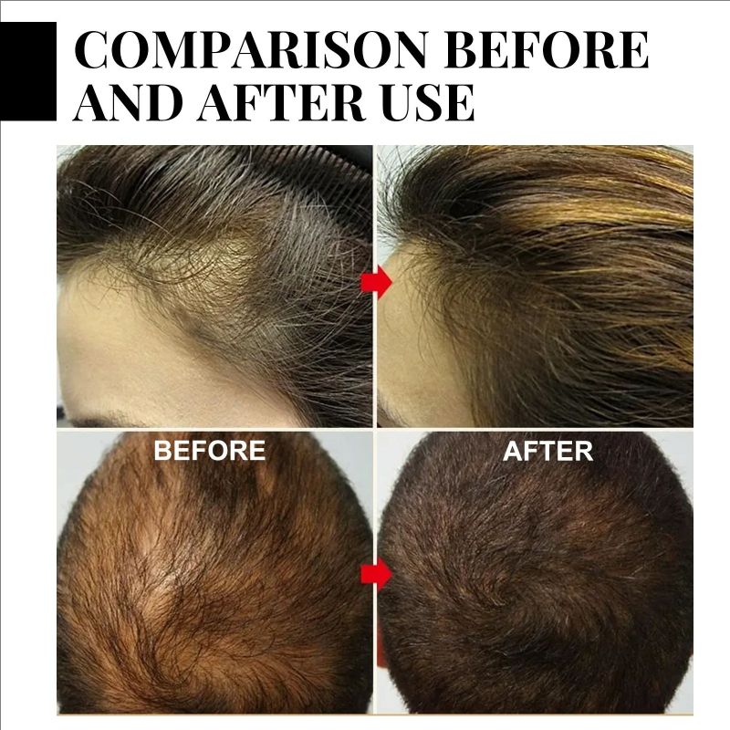 Anti Hair Loss Shampoo Repair Baldness Reduce Dandruff Itching Scalp Treatment Strengthen Thicken Nourishing Hair Growth Shampoo