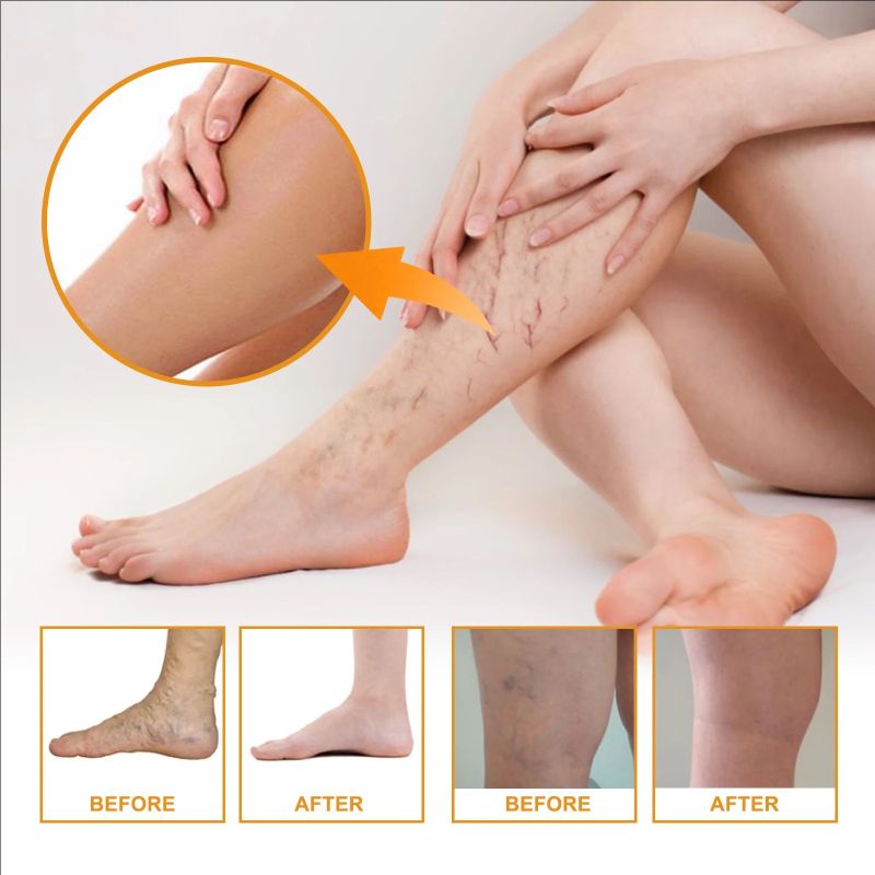 Effective Varicose Vein Relief Cream For Varicose Veins Relieve Vasculitis Phlebitis Spider Pain Ointment For Men Women