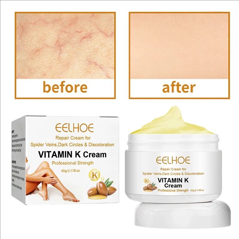 Effective Varicose Vein Relief Cream For Varicose Veins Relieve Vasculitis Phlebitis Spider Pain Ointment For Men Women