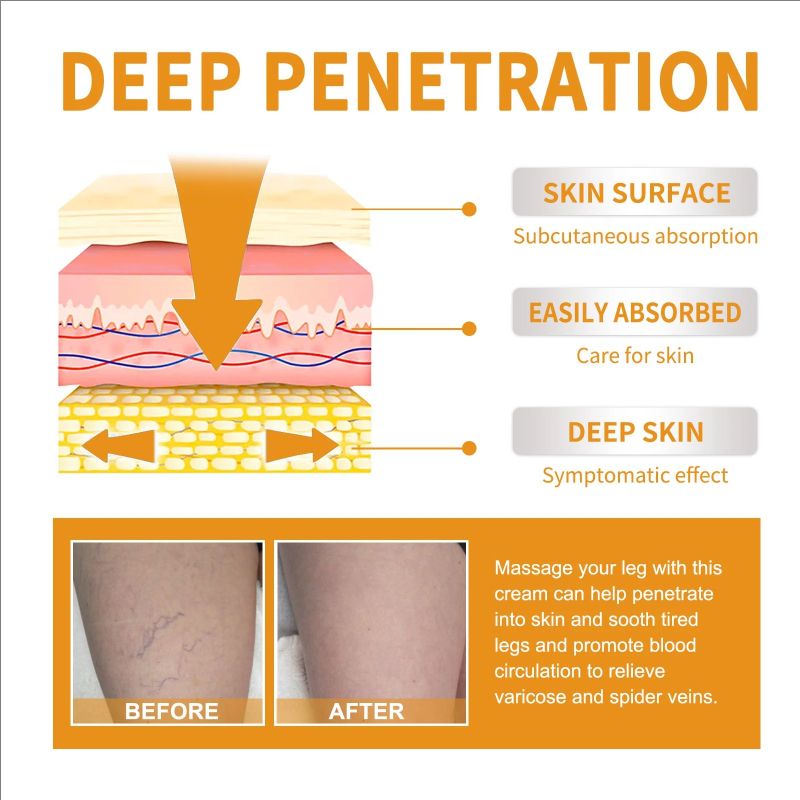 Effective Varicose Vein Relief Cream For Varicose Veins Relieve Vasculitis Phlebitis Spider Pain Ointment For Men Women