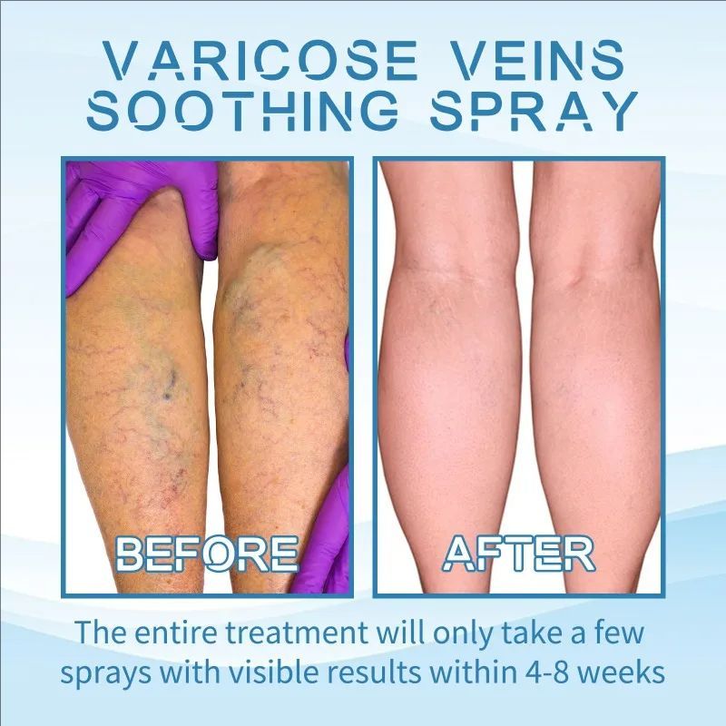 Effective Varicose Vein Relief Spray Relieve Leg Vasculitis Phlebitis Spider Pain Swelling Dredge Meridians Care Repair Spray