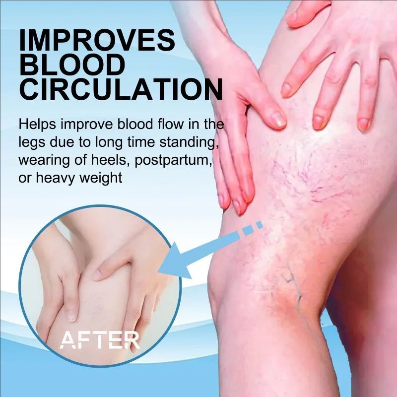Effective Varicose Vein Relief Spray Relieve Leg Vasculitis Phlebitis Spider Pain Swelling Dredge Meridians Care Repair Spray