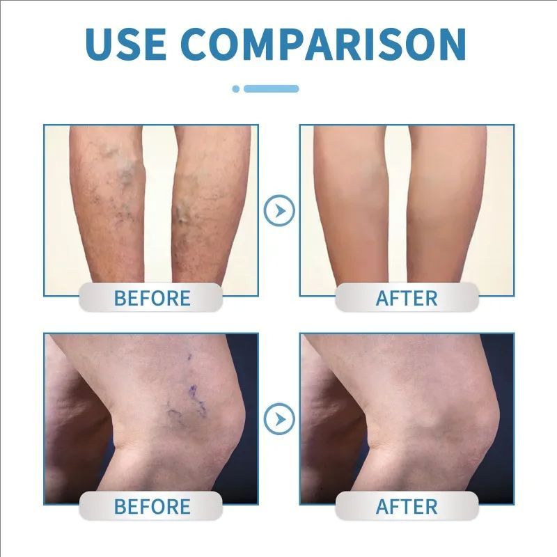 Effective Varicose Vein Relief Spray Relieve Leg Vasculitis Phlebitis Spider Pain Swelling Dredge Meridians Care Repair Spray