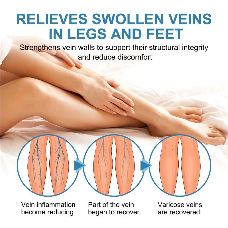 Effective Varicose Vein Relief Spray Relieve Leg Vasculitis Phlebitis Spider Pain Swelling Dredge Meridians Care Repair Spray