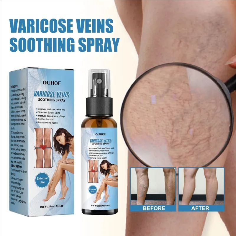 Effective Varicose Vein Relief Spray Relieve Leg Vasculitis Phlebitis Spider Pain Swelling Dredge Meridians Care Repair Spray