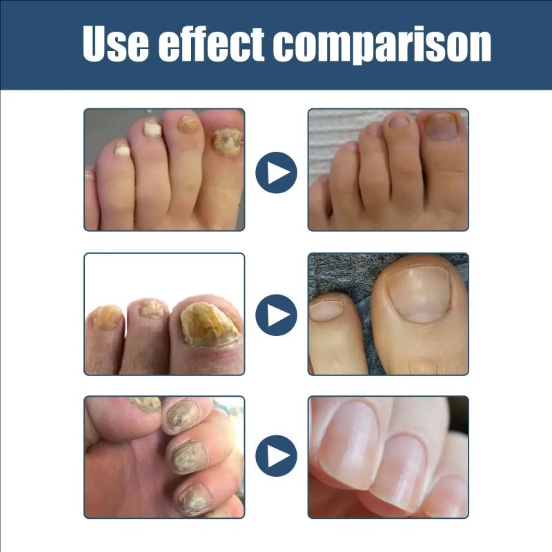 Nail Repair Spray Moisturizing and Cleaning Odor Nails Soft Dry Nails Care Nail Fungus Treatment Onychomycosis Repair Spray Uñas