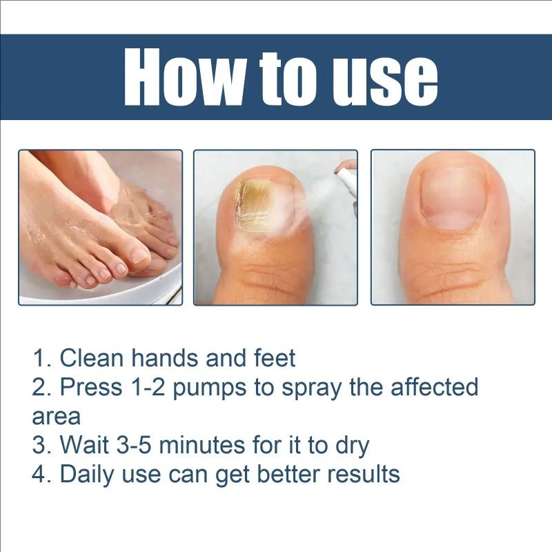 Nail Repair Spray Moisturizing and Cleaning Odor Nails Soft Dry Nails Care Nail Fungus Treatment Onychomycosis Repair Spray Uñas