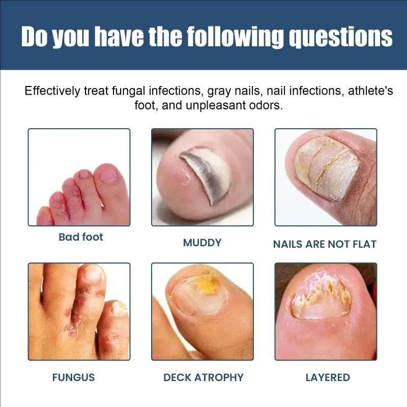 Nail Repair Spray Moisturizing and Cleaning Odor Nails Soft Dry Nails Care Nail Fungus Treatment Onychomycosis Repair Spray Uñas