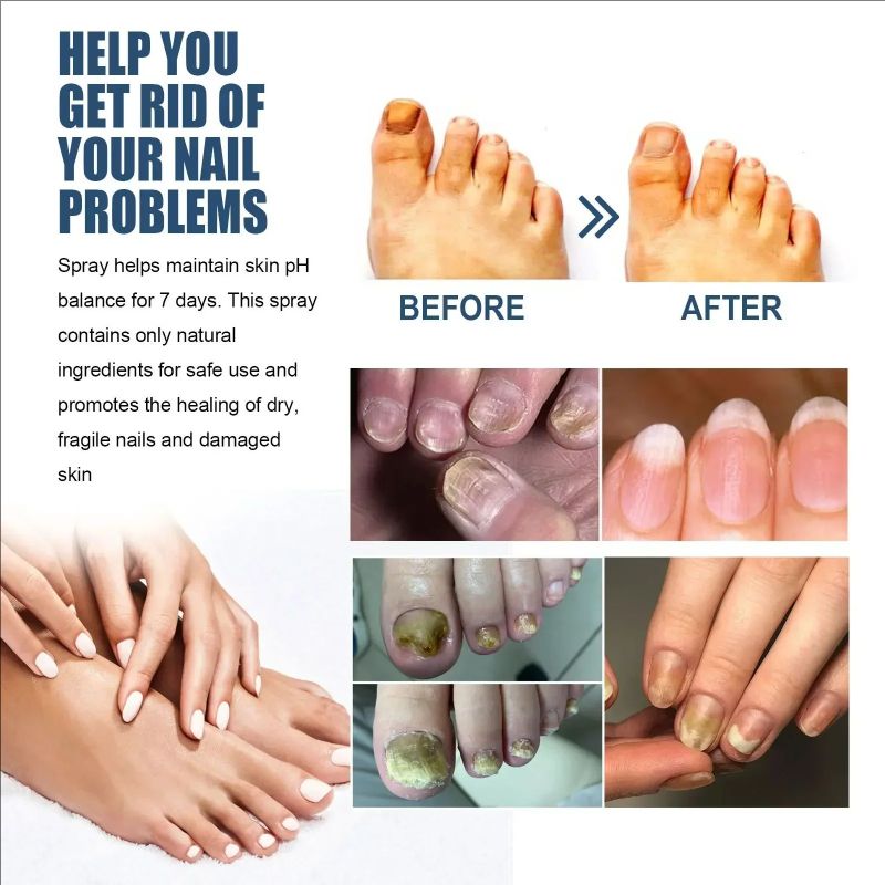 Nail Repair Spray Moisturizing and Cleaning Odor Nails Soft Dry Nails Care Nail Fungus Treatment Onychomycosis Repair Spray Uñas