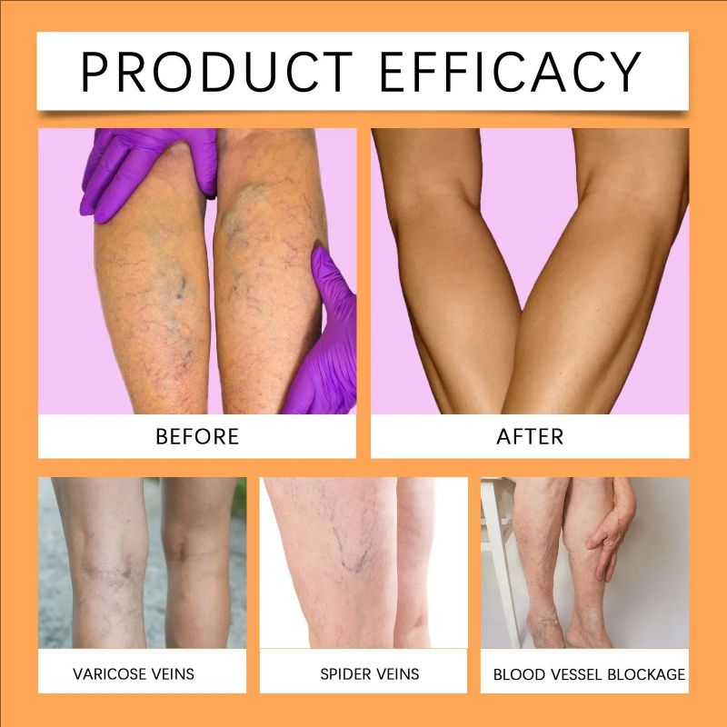12PCS/Bag Unisex Varicose Veins Treatment Patch Legs Sore Swelling Plaster Promote Metabolism Promote Smooth Blood Circulation