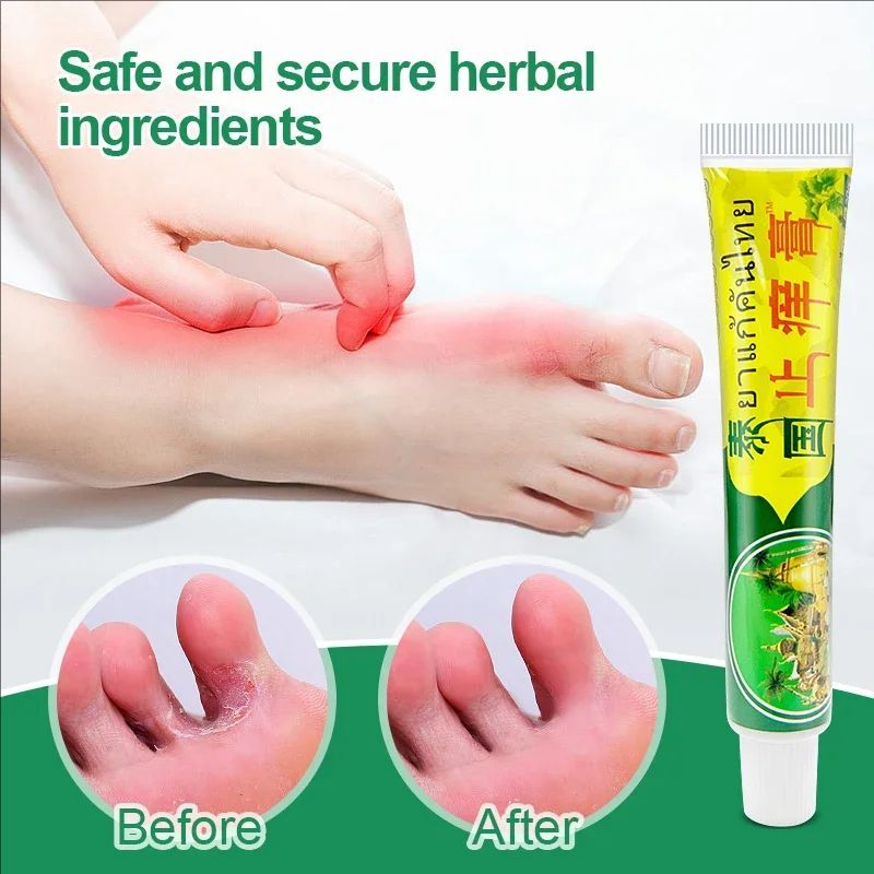 4pcs Thailand Skin Treatment Ointment Psoriasis Cream Anti-itch Repair Damaged Skin Mint Cooling Cream Dermatitis Eczema S074