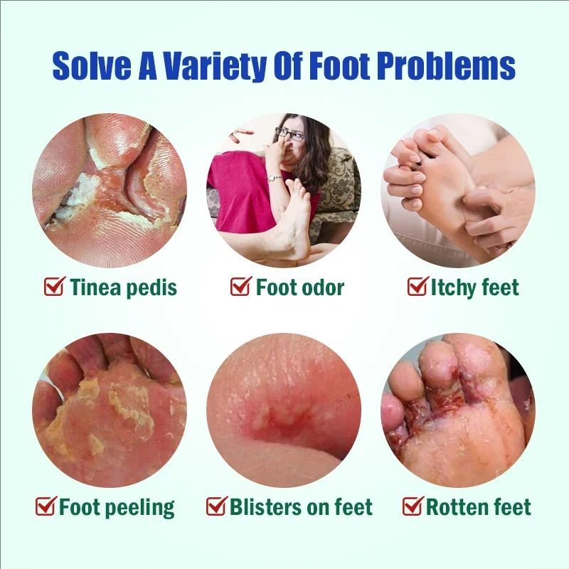 Foot Tinea Pedis Treatment Cream Treat Beriberi Ointment Anti-itch Inhibits Fungus Peeling Athlete Foot Medical Cream A942
