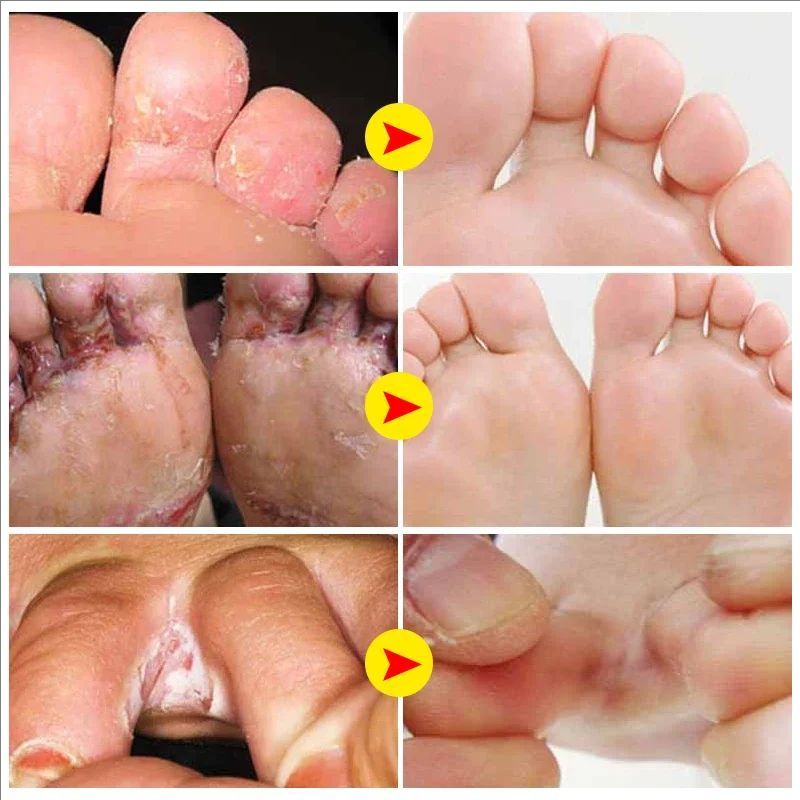 Foot Tinea Pedis Treatment Cream Treat Beriberi Ointment Anti-itch Inhibits Fungus Peeling Athlete Foot Medical Cream A942