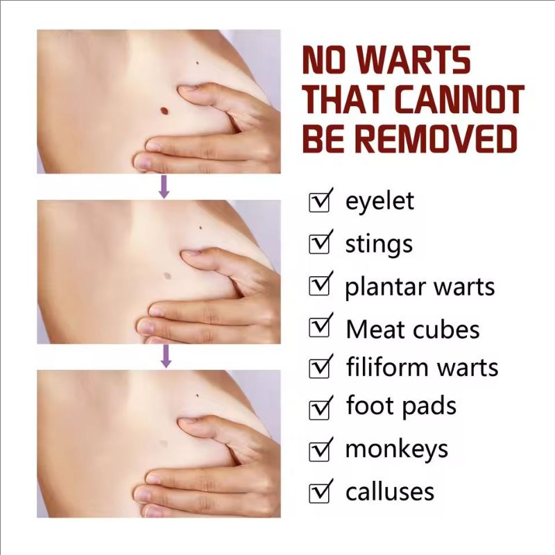Ke Warts Ointment Pen Black Mole Remover Removing Warts Repairing Skin Lightening Black Moles Moisturizing And Caring Product