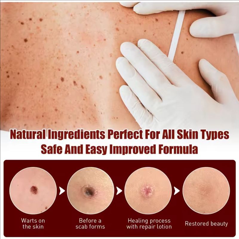 Ke Warts Ointment Pen Black Mole Remover Removing Warts Repairing Skin Lightening Black Moles Moisturizing And Caring Product