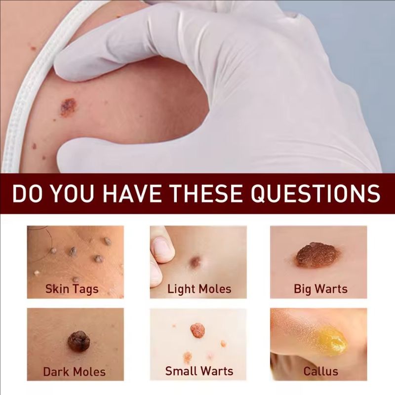 Ke Warts Ointment Pen Black Mole Remover Removing Warts Repairing Skin Lightening Black Moles Moisturizing And Caring Product
