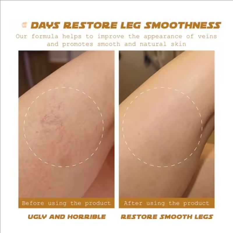 Effective Varicose Vein Relief Cream Ointment For Varicose Veins To Relieve Vasculitis Phlebitis Spider Leg sore Pain Treatment