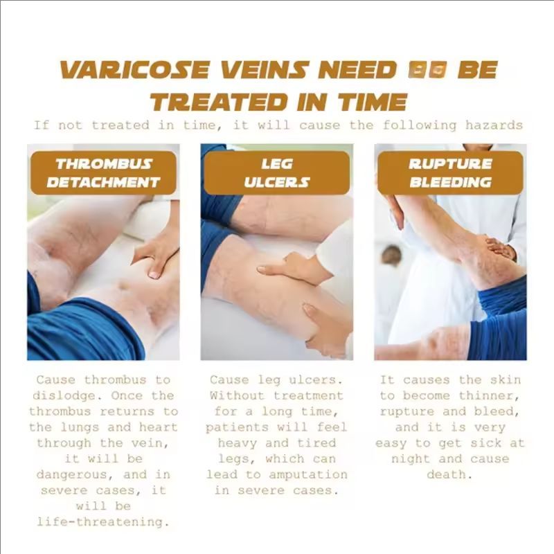 Effective Varicose Vein Relief Cream Ointment For Varicose Veins To Relieve Vasculitis Phlebitis Spider Leg sore Pain Treatment