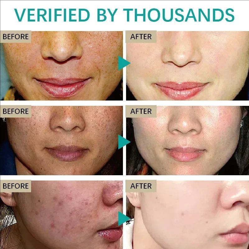 Whitening Freckle Cream Melasma Dark Spots Pigmentation Removal Products Fade Stain Melanin Repair Brighten Korean Skin Care