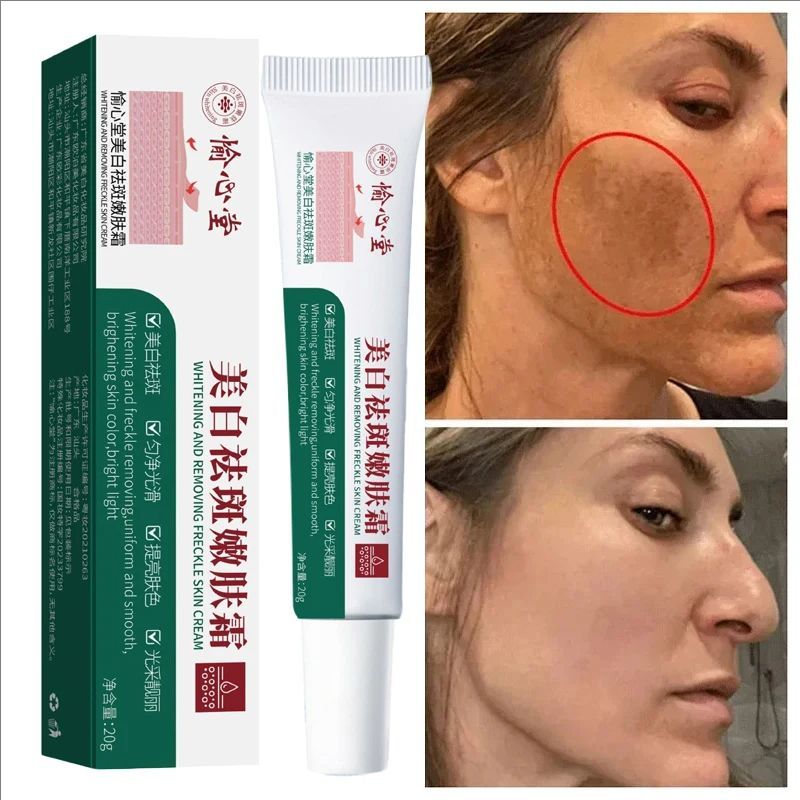 Whitening Freckle Cream Melasma Dark Spots Pigmentation Removal Products Fade Stain Melanin Repair Brighten Korean Skin Care
