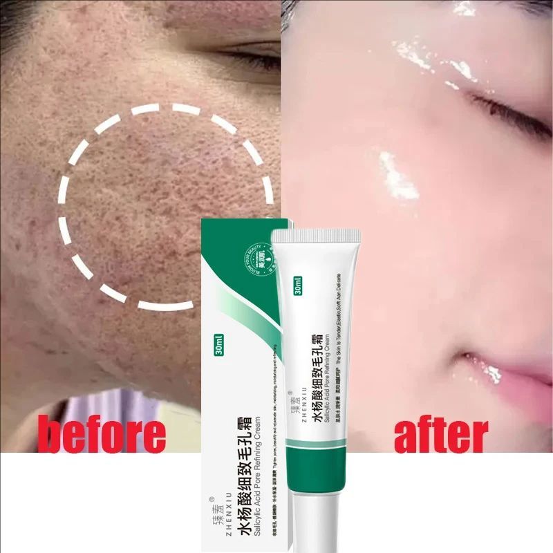 Salicylic Acid Pores Shrink Refining Cream Repair Large Open Pore Removal Black Dots Blackhead Acne Marks Facial Skin Care Serum
