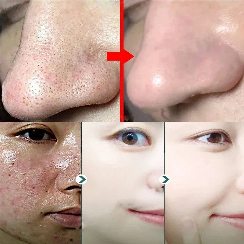 Salicylic Acid Pores Shrink Refining Cream Repair Large Open Pore Removal Black Dots Blackhead Acne Marks Facial Skin Care Serum